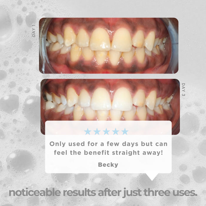 Teeth Whitening Kit Duo Bundle - Icy Bear Dental